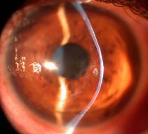 Steroid use after cataract surgery